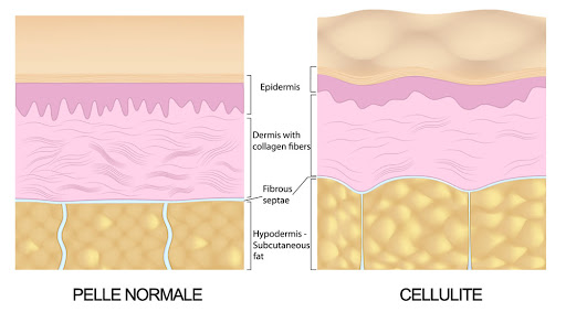 Cellulite o PEFS (1° Parte)