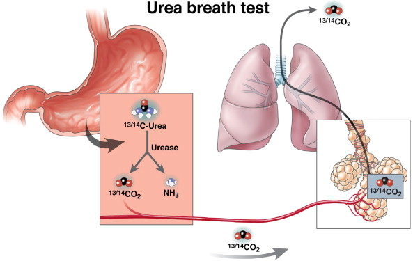 BREATH TEST PER LA DIAGNOSI DELL'HELICOBACTER PYLORI