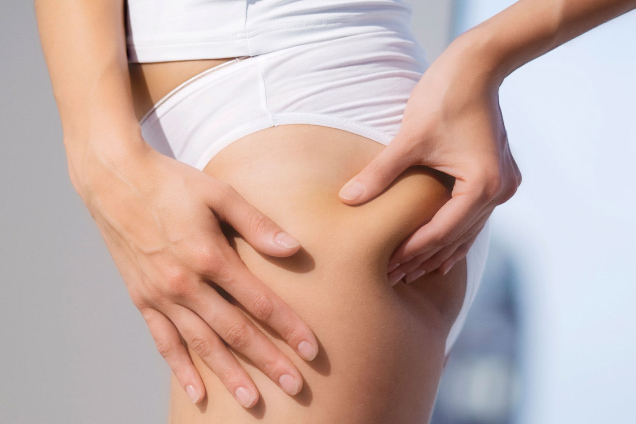 Cellulite o PEFS (2° Parte)