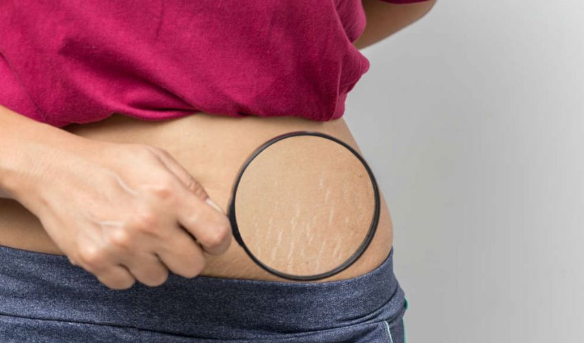 Smagliature o striae distensae