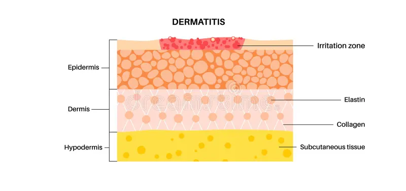 Giornate della Dermatite Atopica
