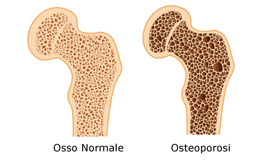 MOC AD ULTRASUONI : UN ESAME UTILE NELLA DIAGNOSI E NEL MONITORAGGIO DELL'OSTEOPOROSI.